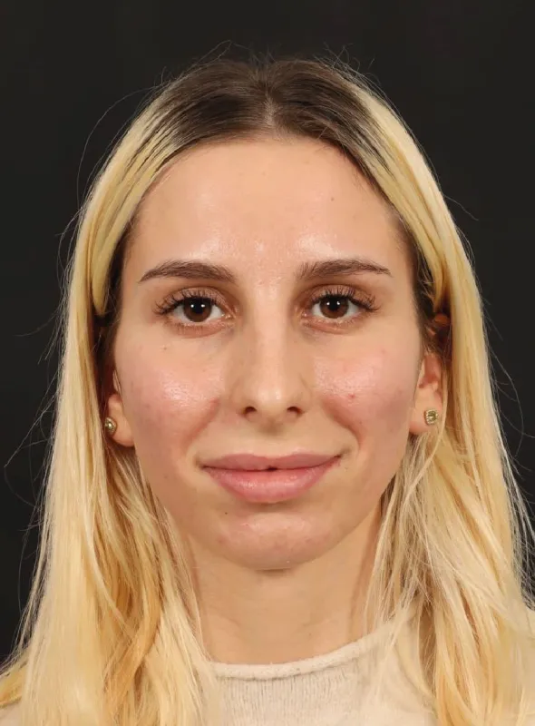 Rinoplasti — ameliyat öncesi, çekim 10.12.2025