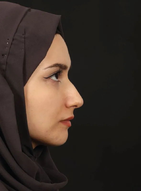 Rinoplasti — ameliyat öncesi, çekim 25.08.2025