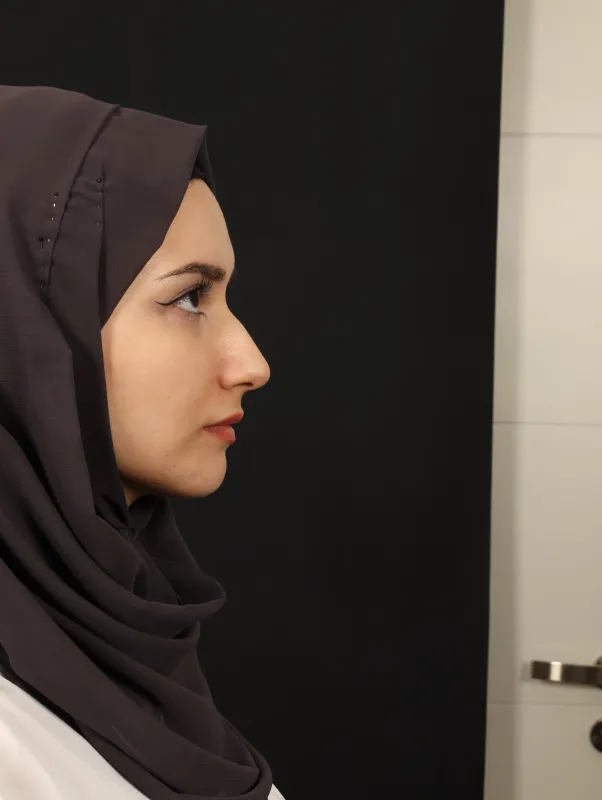 Rinoplasti — ameliyat öncesi, çekim 25.08.2025