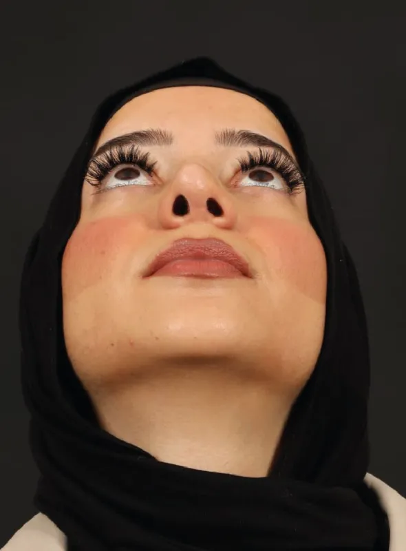 Rinoplasti — ameliyat öncesi, çekim 15.12.2025