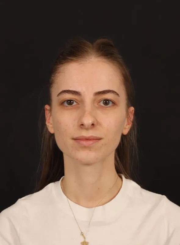 Rinoplasti — ameliyat öncesi, çekim 18.03.2026