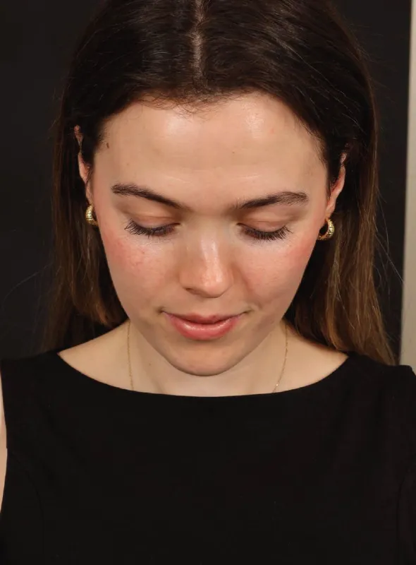 Rinoplasti — ameliyat öncesi, çekim 01.06.2026