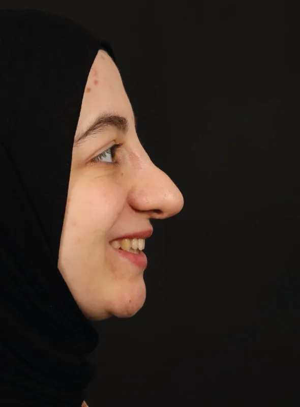 Revizyon Rinoplasti (Revizyon Burun Estetiği) — ameliyat öncesi, çekim 16.04.2025