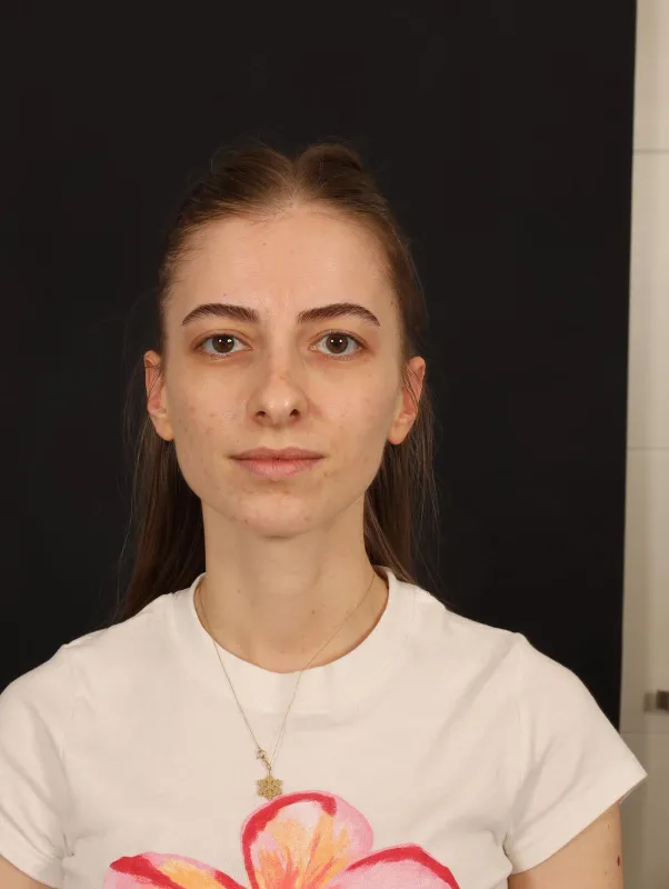Rinoplasti — ameliyat öncesi, çekim 18.03.2026