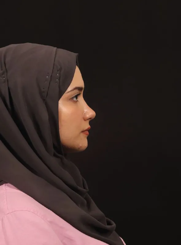 Rinoplasti — ameliyat sonrası, çekim 20.08.2026