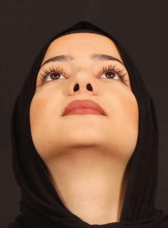 Rinoplasti — ameliyat sonrası, çekim 12.08.2026
