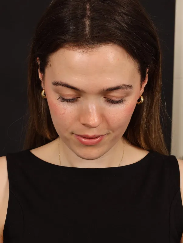 Rinoplasti — ameliyat öncesi, çekim 01.06.2026