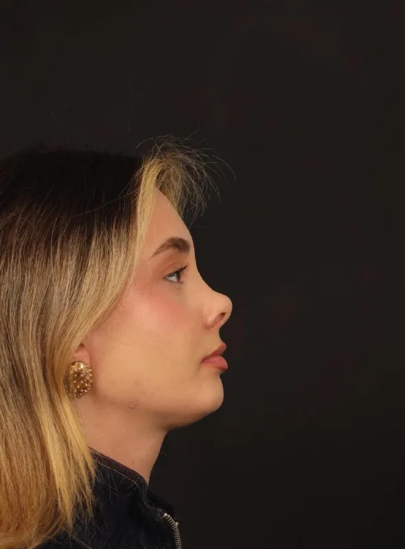 Rinoplasti — ameliyat öncesi, çekim 16.05.2026