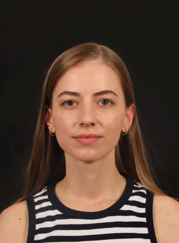Rinoplasti — ameliyat sonrası, çekim 28.08.2026
