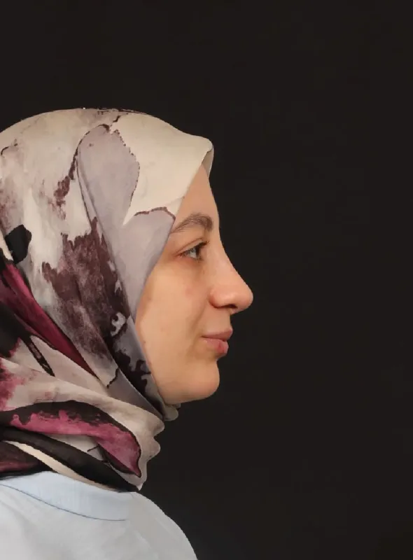 Revizyon Rinoplasti (Revizyon Burun Estetiği) — ameliyat sonrası, çekim 26.08.2026