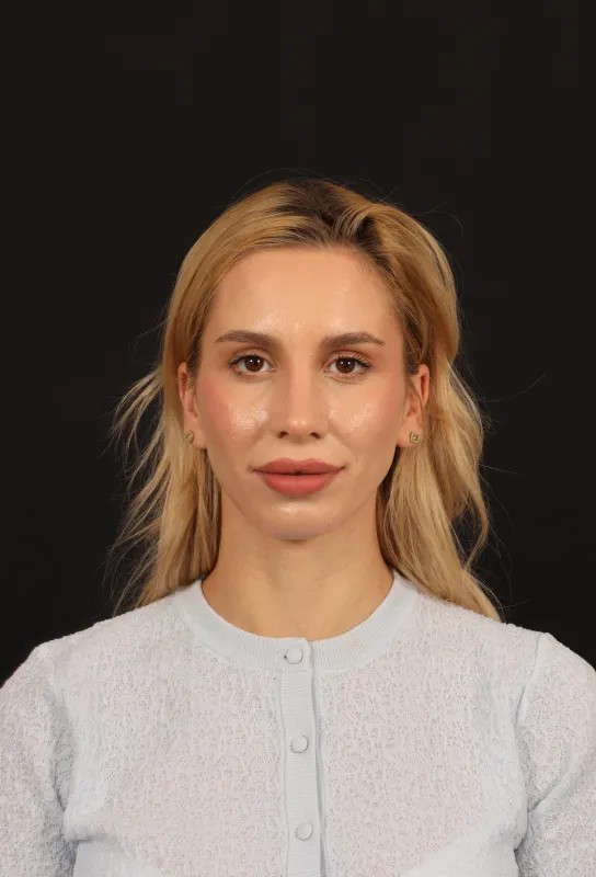 Rinoplasti — ameliyat sonrası, çekim 15.06.2026