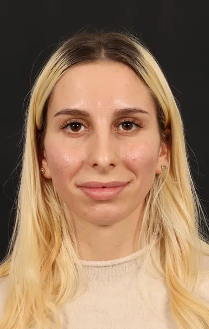 Rinoplasti — ameliyat öncesi, çekim 10.12.2025