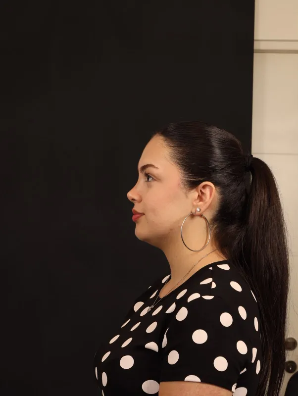 Revizyon Rinoplasti — ameliyat sonrası, çekim 28.08.2026