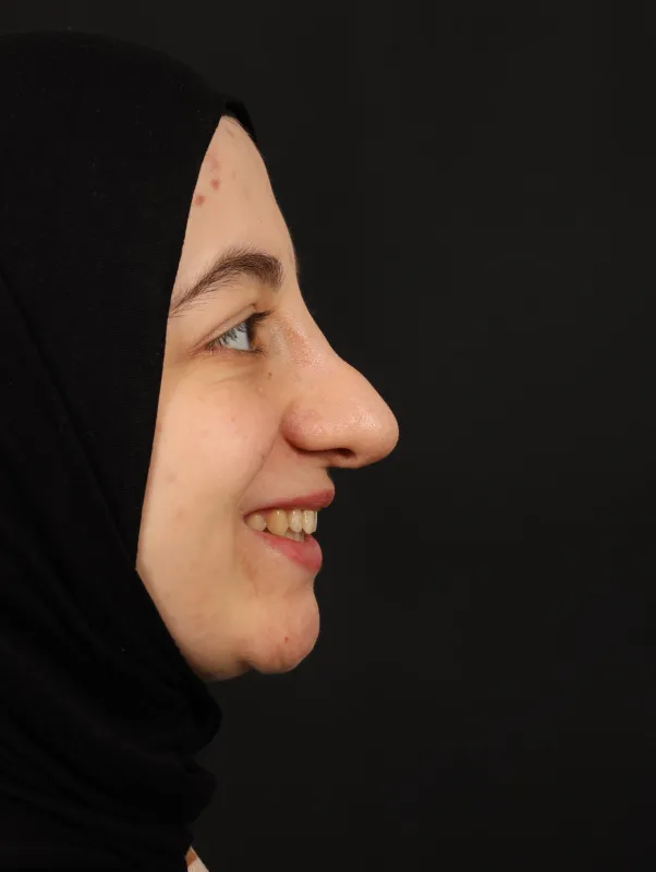 Revizyon Rinoplasti — ameliyat öncesi, çekim 16.04.2025